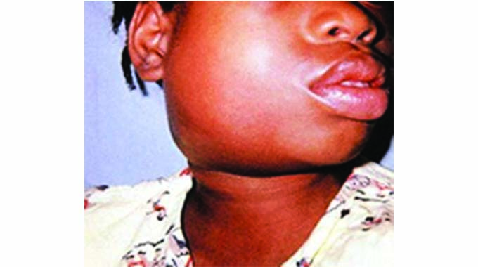 Mumps outbreak runs for 12 months in Bulawayo